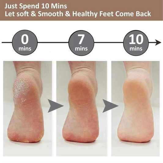 Electric Callus Remover - Dead Skin Pedicure Tool